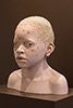 African-child-with-Albinism-3-2