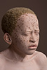 African-Child-with-Albinism-4-3