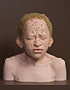 African-Child-with-Albinism-4