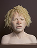 African-Teen-with-Albinism